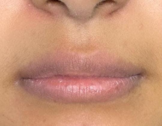 Antes de aumento de labios