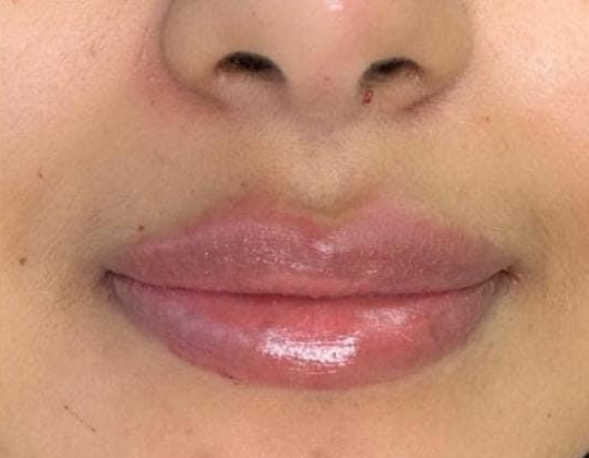 Después de aumento de labios