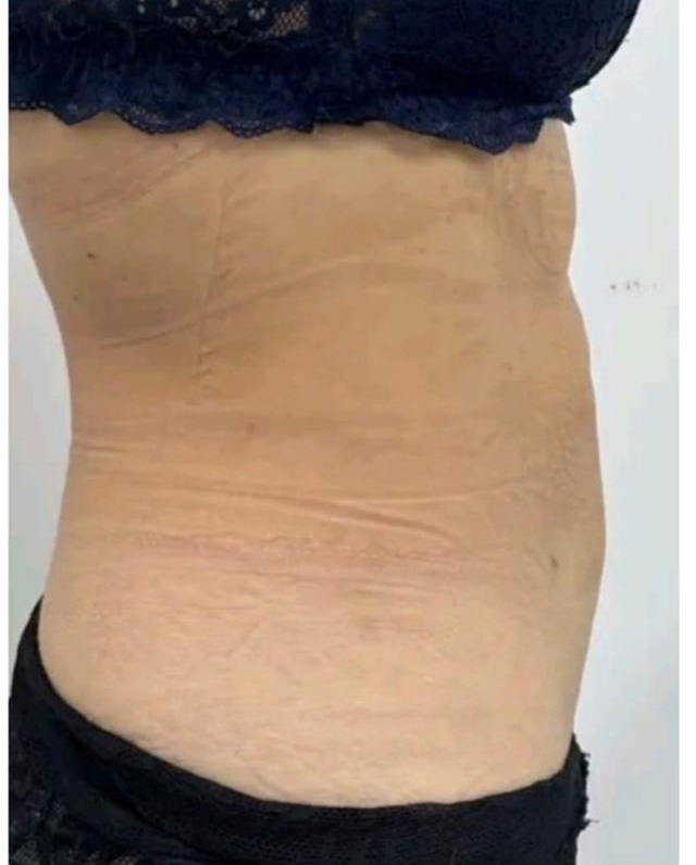 Después de moldeo corporal